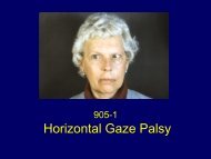 Horizontal Gaze Palsy