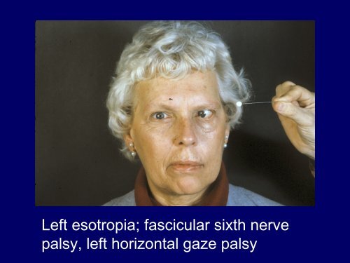 Horizontal Gaze Palsy