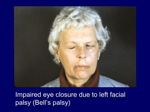 Horizontal Gaze Palsy