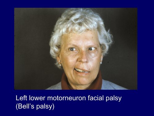 Horizontal Gaze Palsy