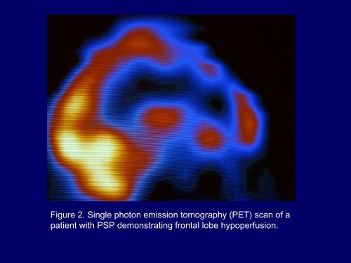 Progressive Supranuclear Palsy