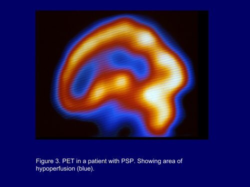 Progressive Supranuclear Palsy