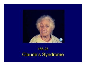 Claude's Syndrome