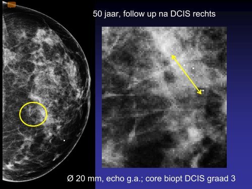 De waarde van MRI bij DCIS - NKI-AVL