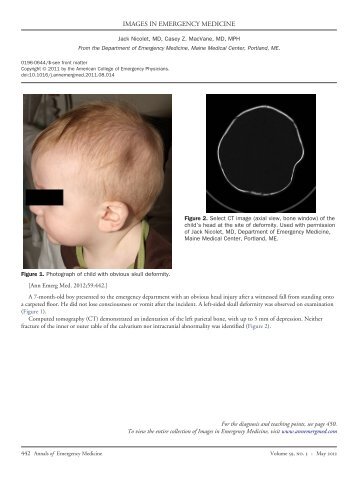 Avulsion fracture of the lesser trochanter: an unusual ...