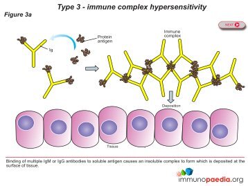 Type 3 - immune complex hypersensitivity - Immunopaedia