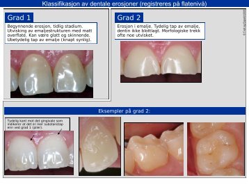 Klassifikasjon av dentale erosjoner