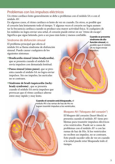 ¿Qué es un marcapasos? - PDF Se abre una ventana nueva.