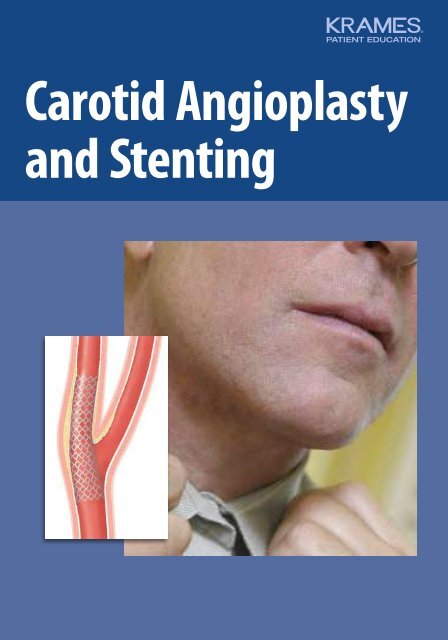 Carotid Angioplasty and Stenting - Veterans Health Library