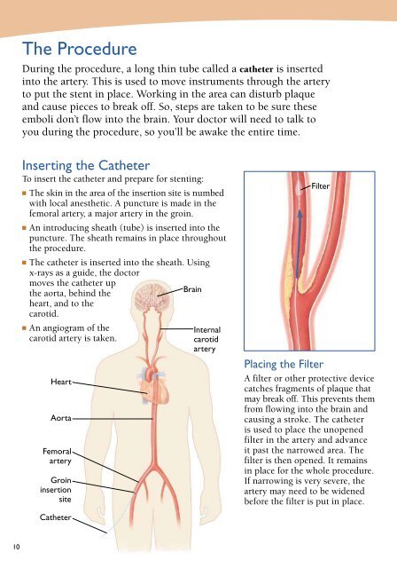 Carotid Angioplasty and Stenting - Veterans Health Library