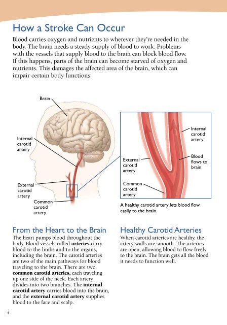 Carotid Angioplasty and Stenting - Veterans Health Library