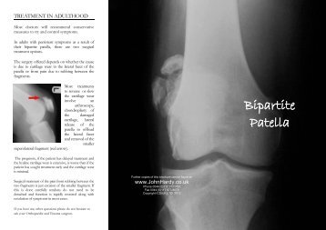 Bipartite Patella Information - Knee Surgeon