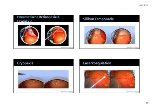 FundusverÃ¤nderung bei hoher Myopie Workshop - Optometrie ...