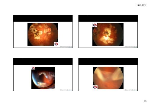 FundusverÃ¤nderung bei hoher Myopie Workshop - Optometrie ...