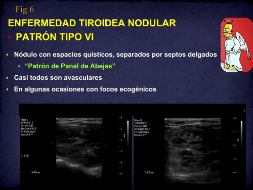 ENFERMEDAD TIROIDEA NODULAR PATRÓN TIPO V