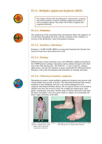 IX./2.: Multiplex epiphyseal dysplasia (MED)