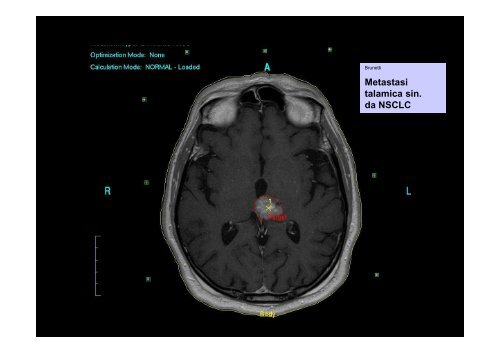 Radioterapia Stereotasica