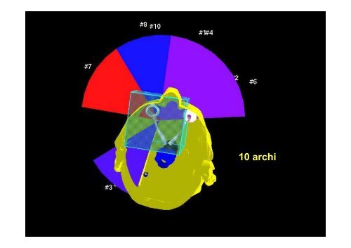 Radioterapia Stereotasica