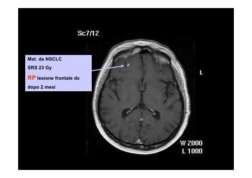 Radioterapia Stereotasica