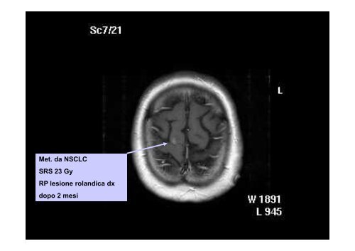 Radioterapia Stereotasica