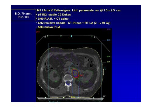 Radioterapia Stereotasica