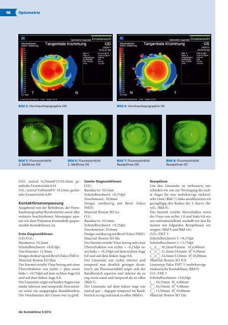 Cornea plana congenita und Kontaktlinsen - Optometrie Cagnolati