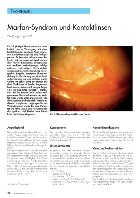 Marfan-Syndrom und Kontaktlinsen - Optometrie Cagnolati