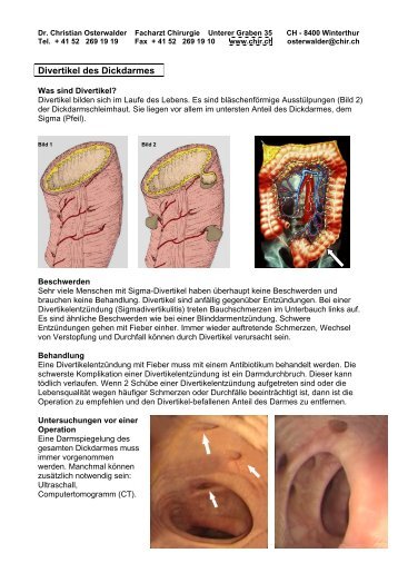 Divertikel des Dickdarmes - chir.ch