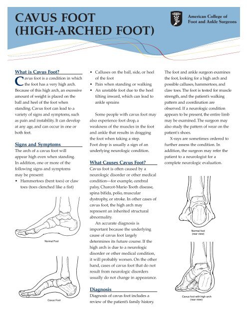 CAVUS FOOT (HIGH-ARCHED FOOT)