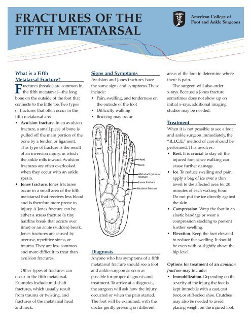 FRACTURES OF THE FIFTH METATARSAL
