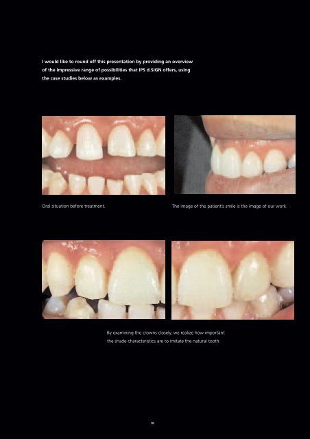 Shade characteristics of natural teeth