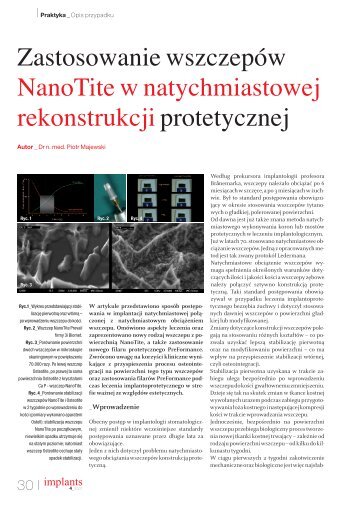 Zastosowanie wszczepÃ³w NanoTite w ... - Dental-Depot