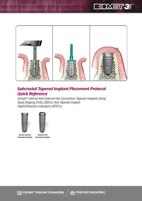 Subcrestal Tapered Implant Placement Protocol ... - Dental-Depot