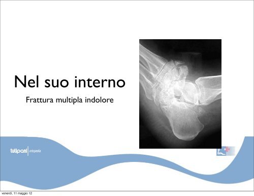 neuro-osteoartropatia di Charcot - orthoswiss