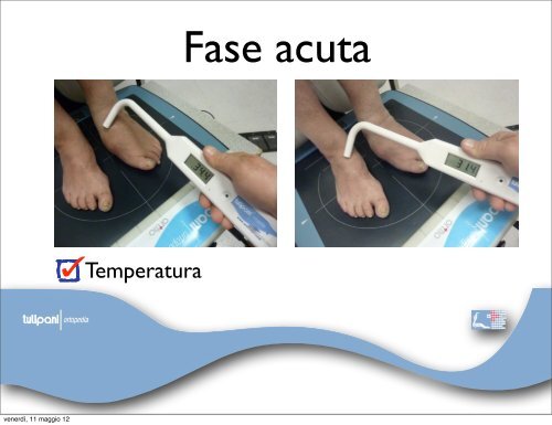 neuro-osteoartropatia di Charcot - orthoswiss