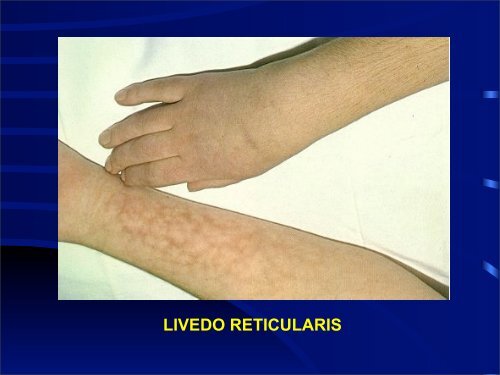 Vasculitis de Grandes y Medianos Vasos - eTableros