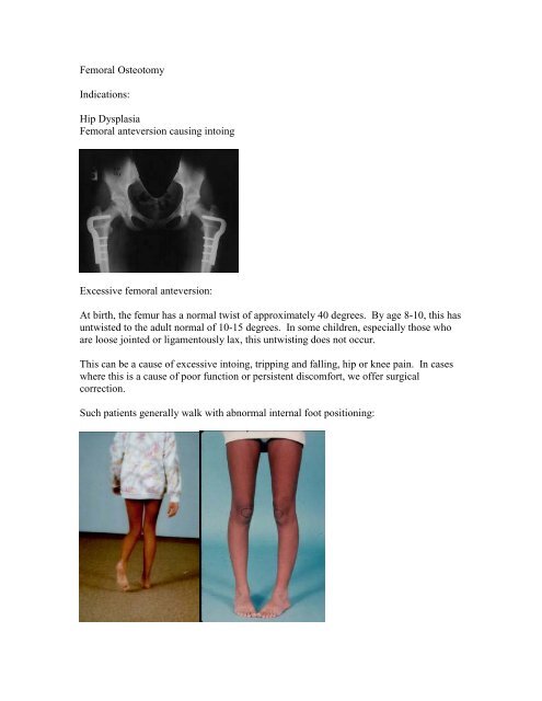 Femoral Osteotomy - CT-Ortho.com