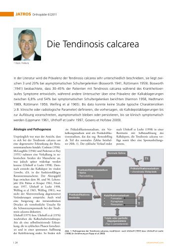 Die Tendinosis calcarea - zentrum sportorthopädie freiburg