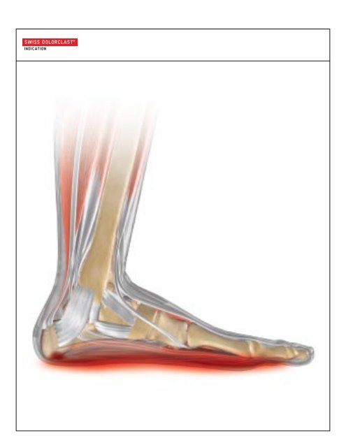 Swiss DolorClast Â® Brochure - Ortho Providers