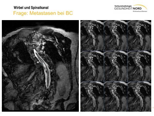 Wirbel und Spinalkanal