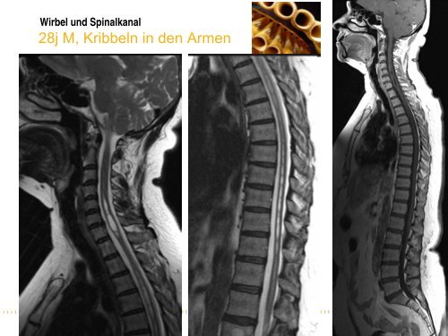 Wirbel und Spinalkanal