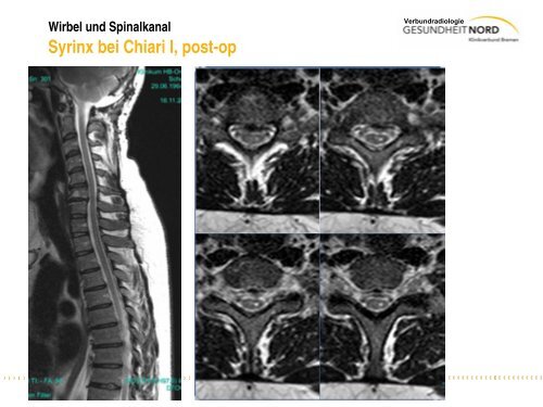 Wirbel und Spinalkanal