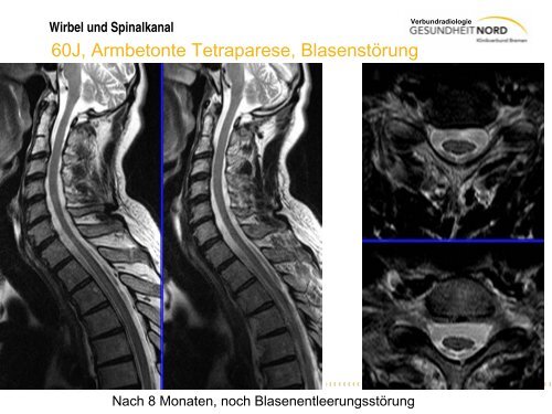 Wirbel und Spinalkanal