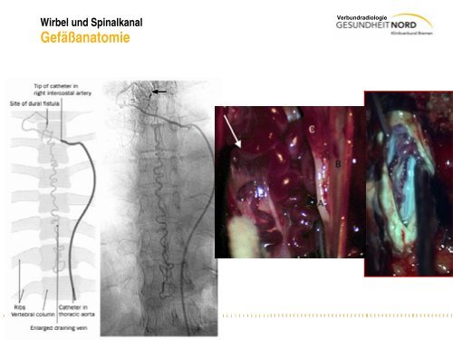 Wirbel und Spinalkanal