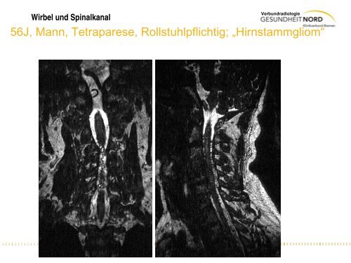 Wirbel und Spinalkanal