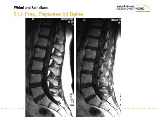 Wirbel und Spinalkanal