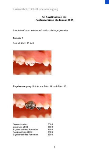 Festzuschuss Zahnersatz - Beispielrechnung