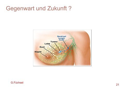 Neues zur Behandlung des Brustkrebses