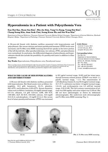 Hypercalcemia in a Patient with Polycythemia Vera