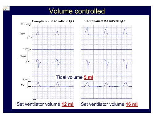 Volume Targeted Ventilation in Preterm Infants